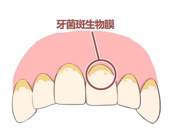 牙菌斑怎麼去除
