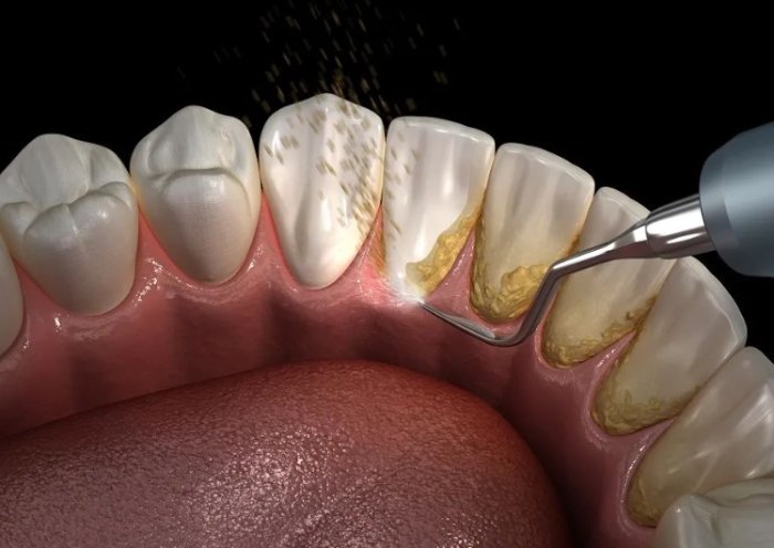 洗牙後注意事項
