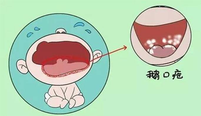 口腔念珠菌初期