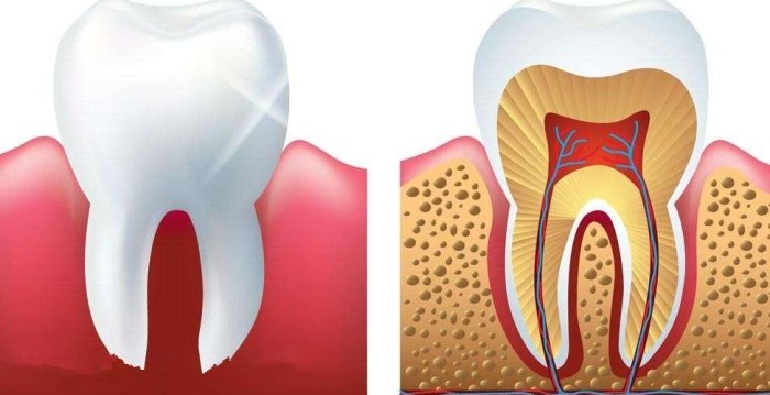 牙髓炎怎麼引起的