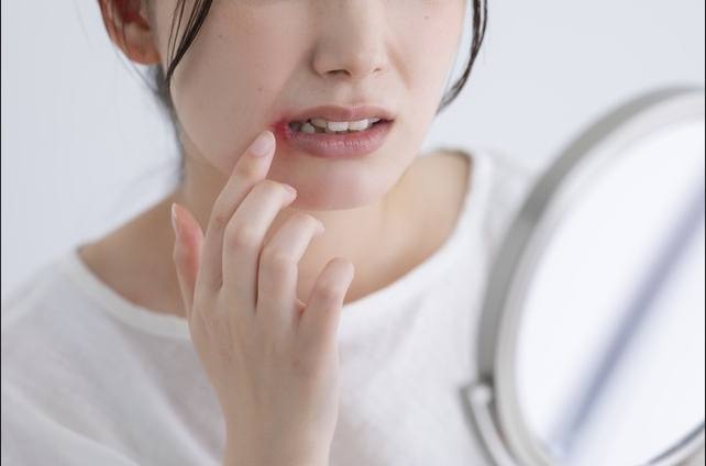 口角炎怎麼治療