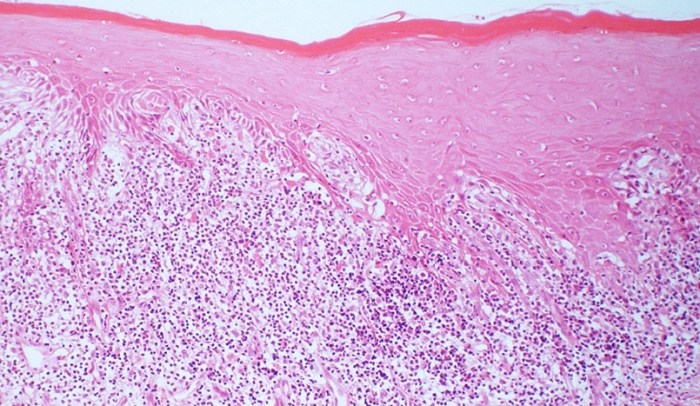 什麼是扁平苔癬