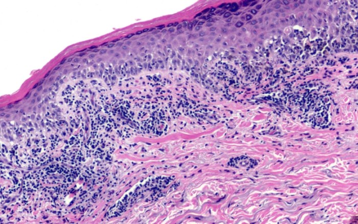 口腔扁平苔蘚症狀