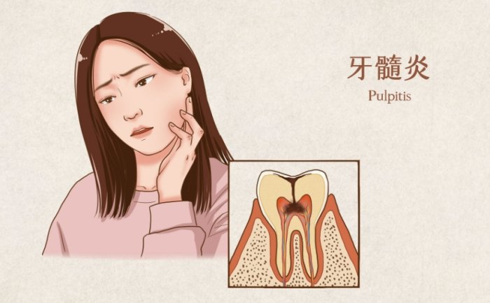 牙髓炎疼痛級別