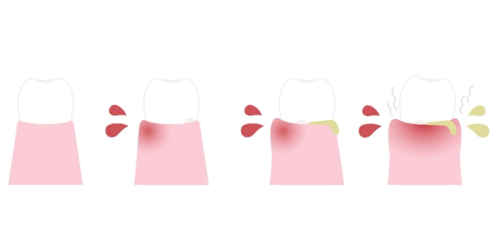 牙菌斑多久形成