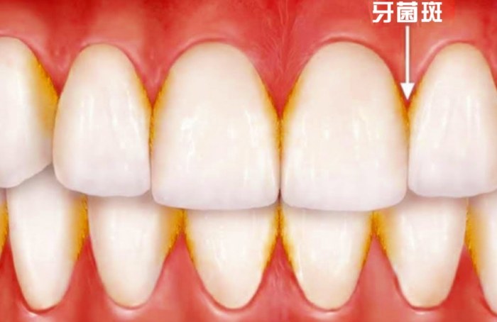 牙菌斑多久形成