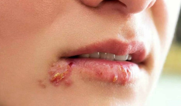 嘴唇皰疹原因
