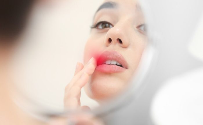 嘴唇皰疹怎麼治療