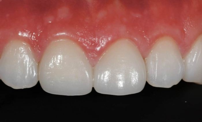 免磨牙瓷牙貼片