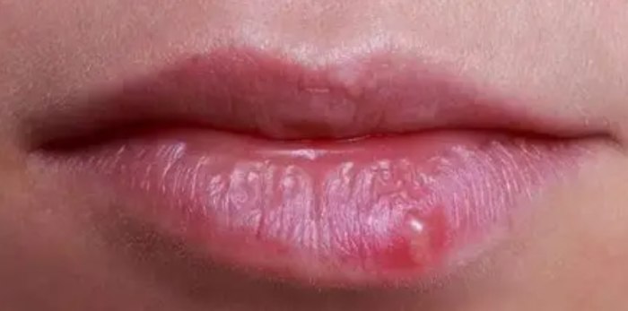 嘴唇皰疹吃什麼