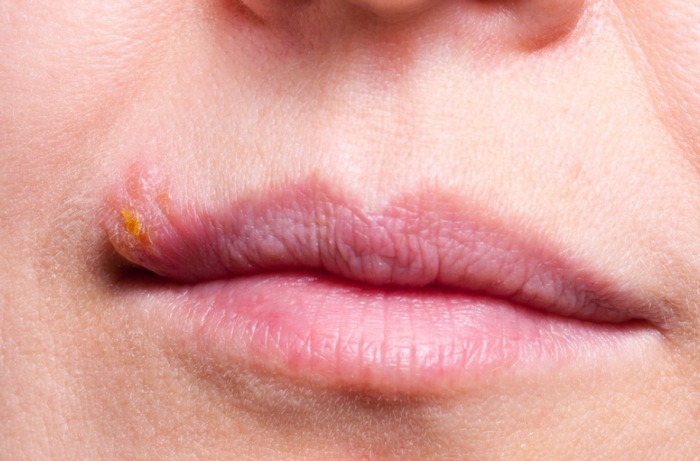 嘴唇皰疹原因