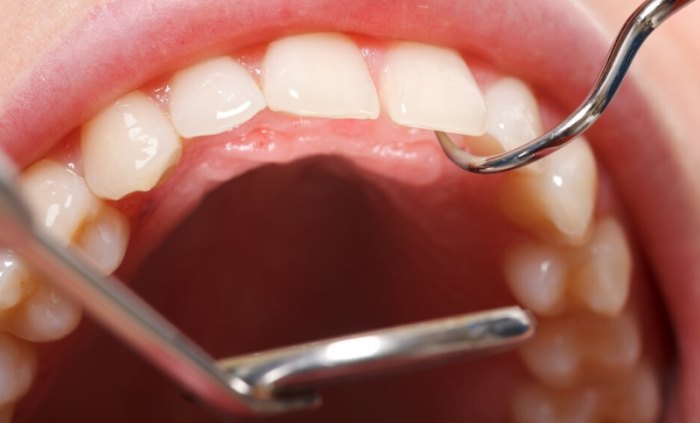 牙結石怎麼去除
