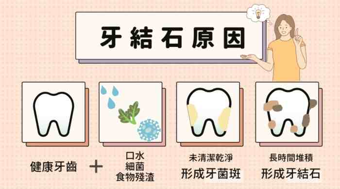 如何避免牙結石