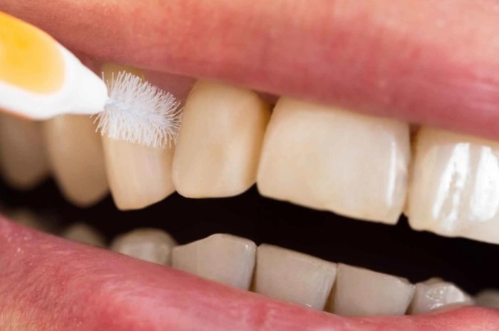 牙結石是怎麼形成的