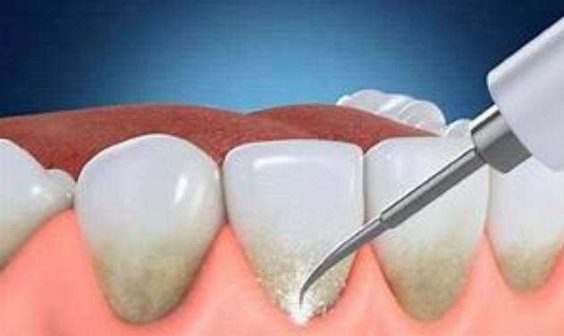 牙結石長什麼樣