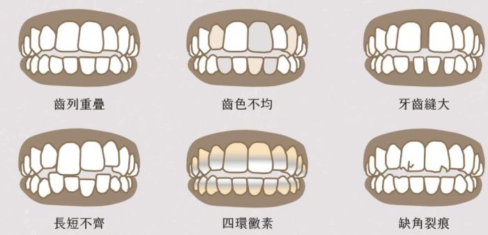 牙齒貼片後遺症