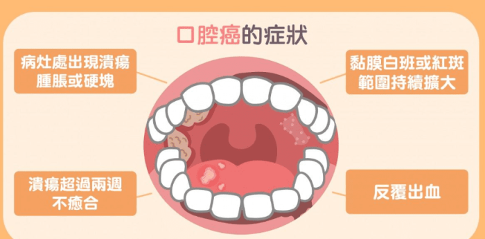 口腔癌前兆 口腔癌前兆