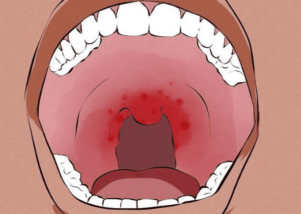 ​口腔潰瘍的常見成因