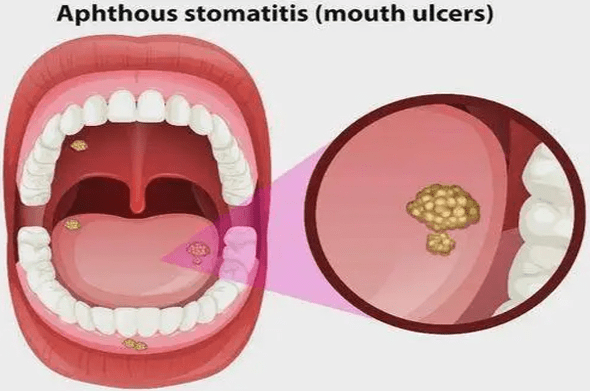口腔癌早期症狀 口腔癌早期症狀