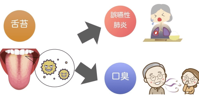 舌苔清潔​工具