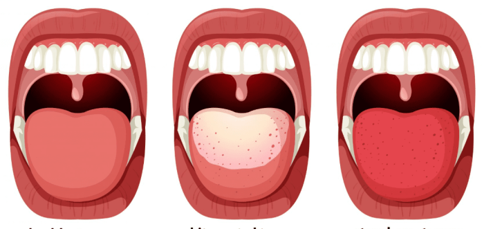 口腔黑點瘀血​症狀