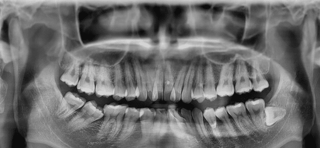 阻生智齒的定義