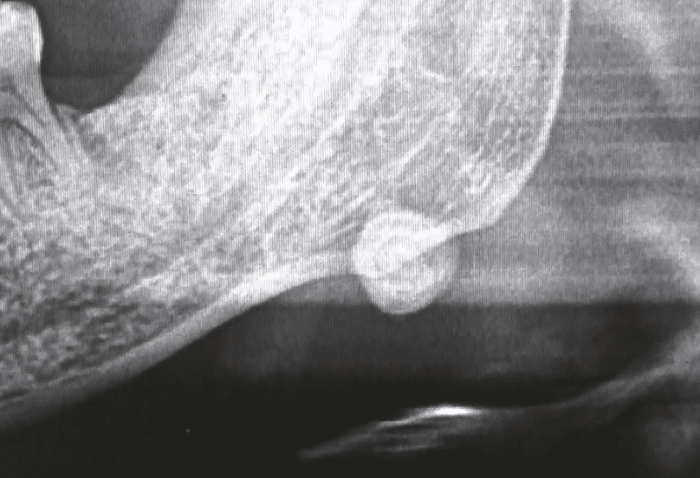 唾液腺結石常見3種症狀