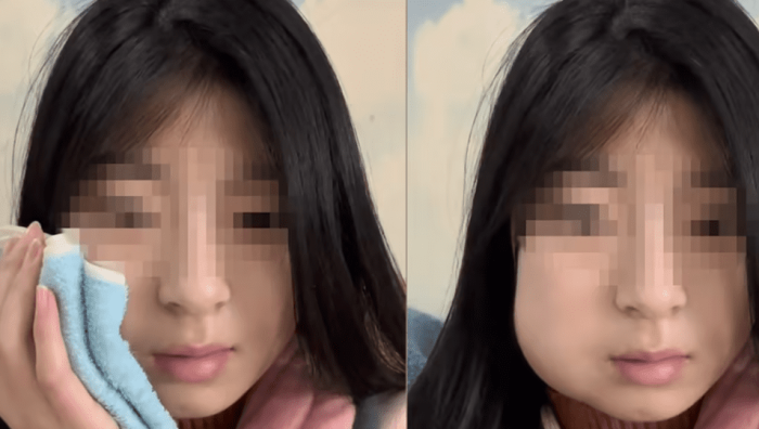 阻生智齒的原因