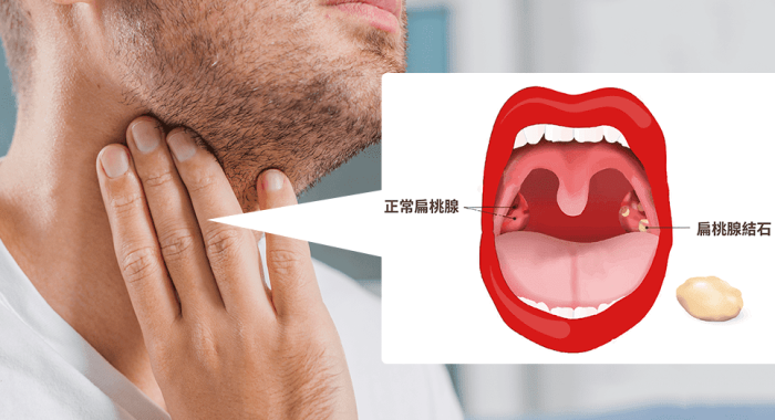 唾液腺結石治療方法