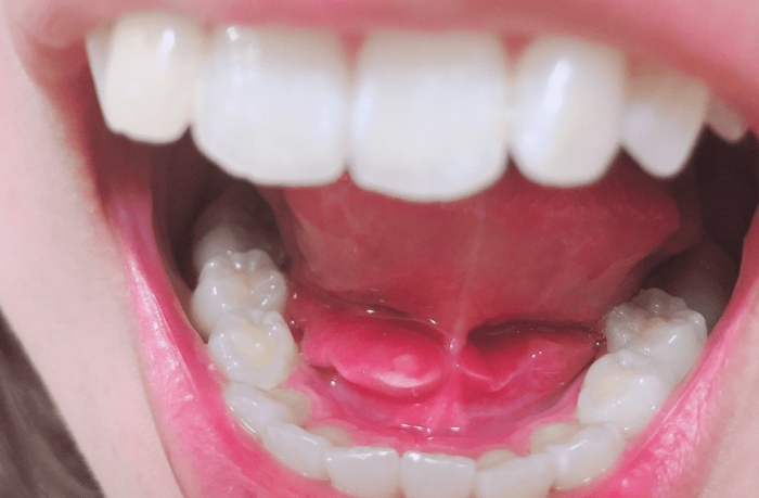 唾液腺結石如何診斷