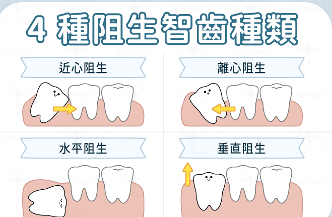 阻生智齒的症狀