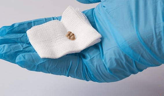 易形成唾液腺結石的6種高風險因子