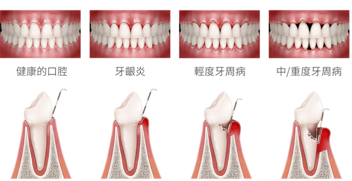 牙周病7大症狀