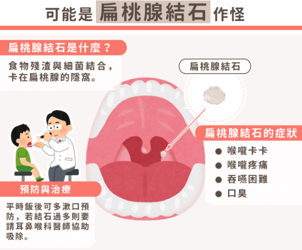 唾液腺結石常見3種症狀