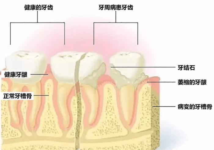 牙周病原因是什麼