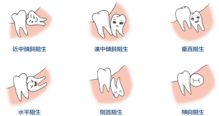 阻生智齒的風險因素