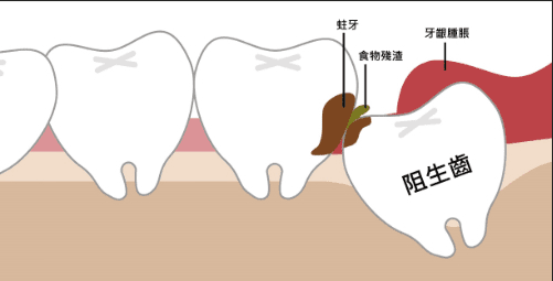 阻生智齒的定義